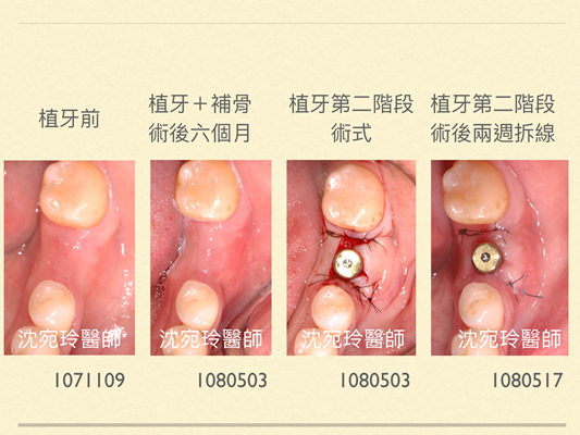 談植牙 第二階段術式 佳誠美學牙醫診所
